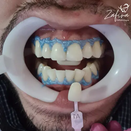 Antes e depois - Clareamento