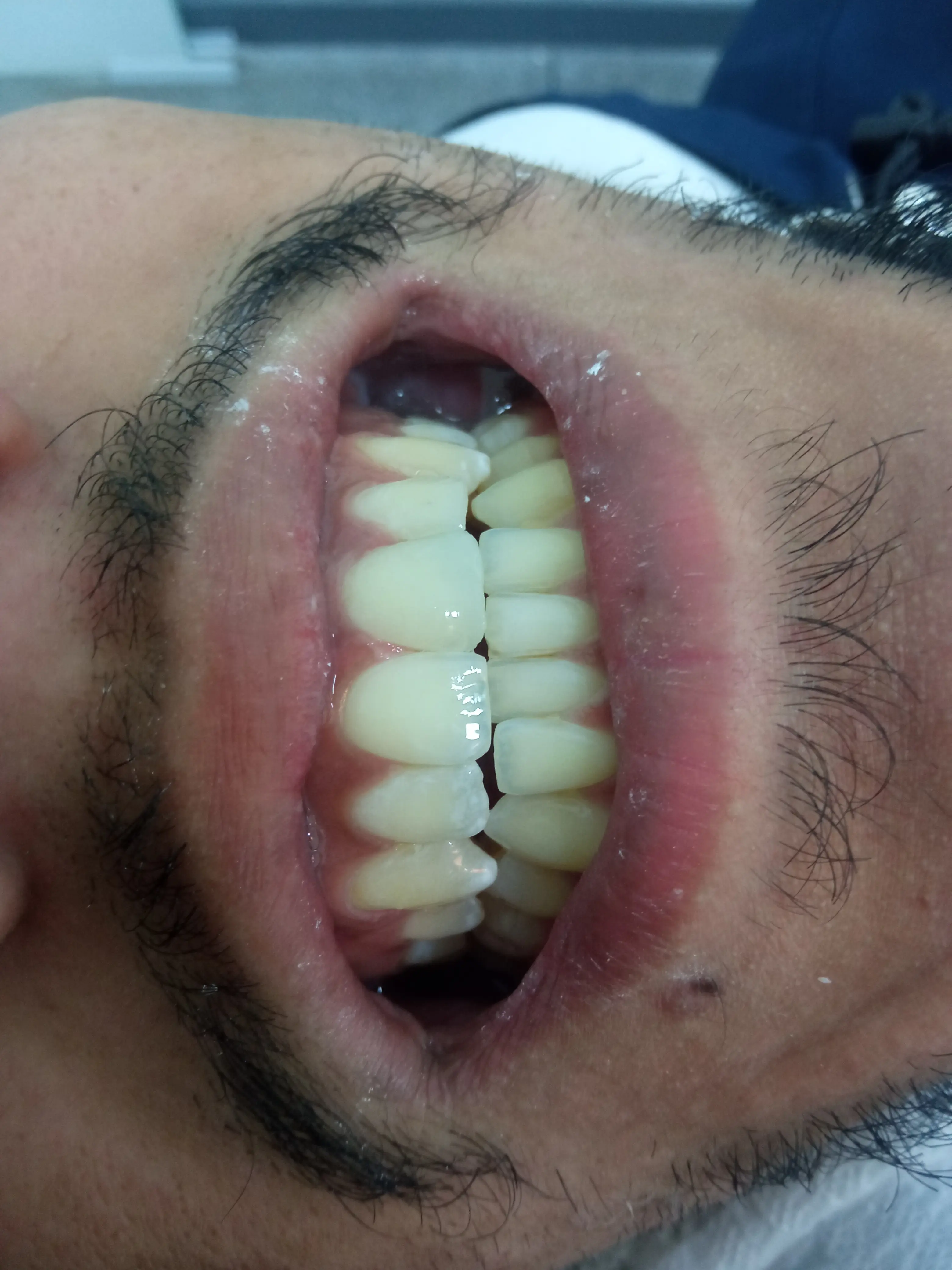 Antes e depois - Clareamento Zafira