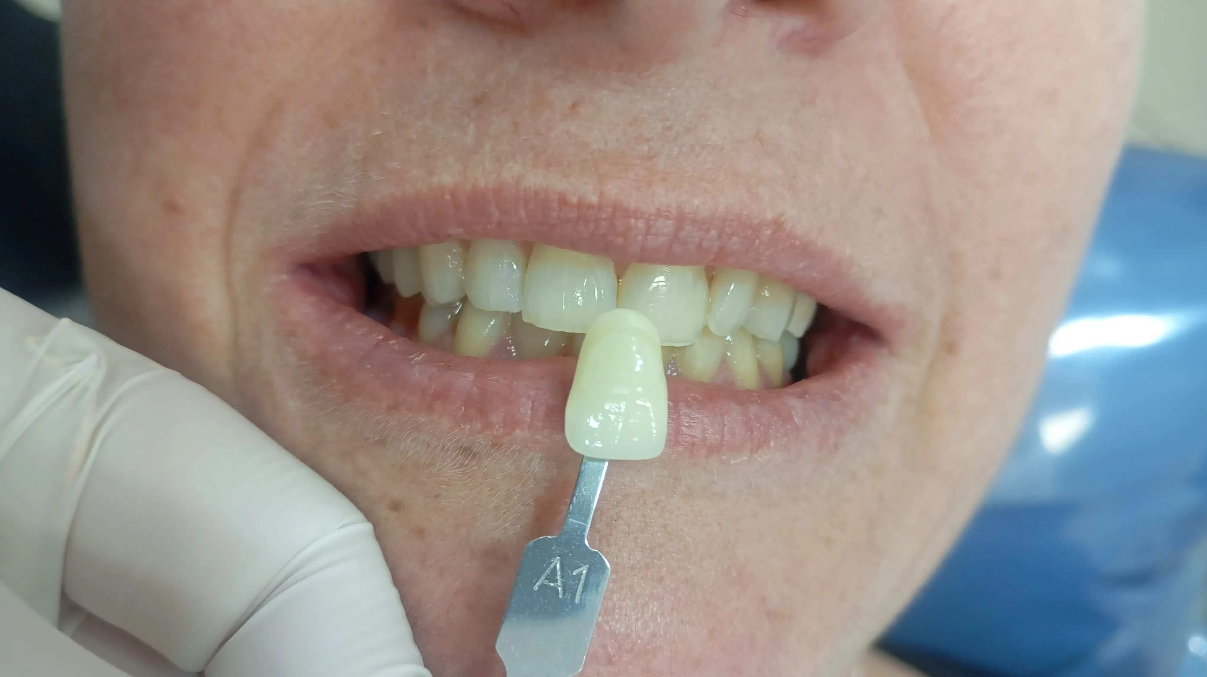 Antes e depois - Clareamento Zafira 2