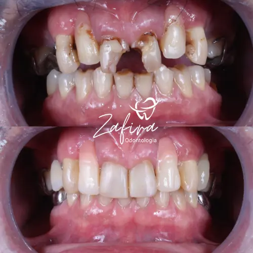 Antes e depois - Facetas