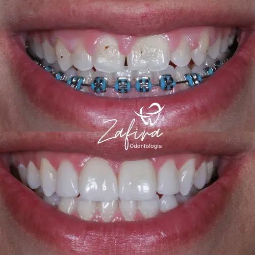 Antes e depois - Facetas